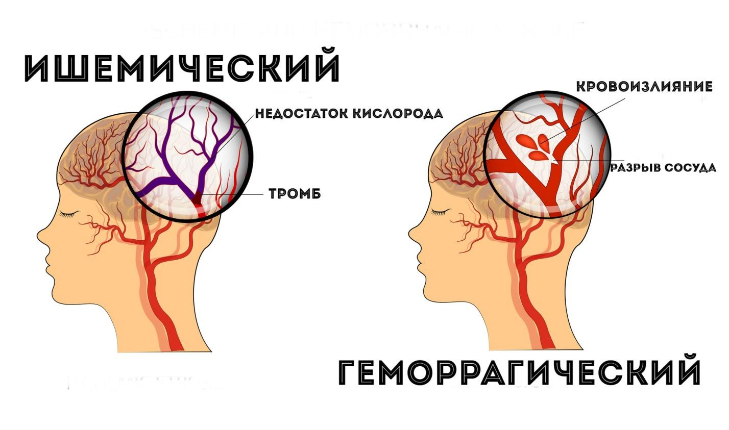 Инсульт что это. Ишемический и геморрагический инсульт головного мозга. Субарахноидальный геморрагический инсульт симптомы. Ишемический инсульт и геморрагический инсульт. Геморрагический инсульт 2. ишемический инсульт.